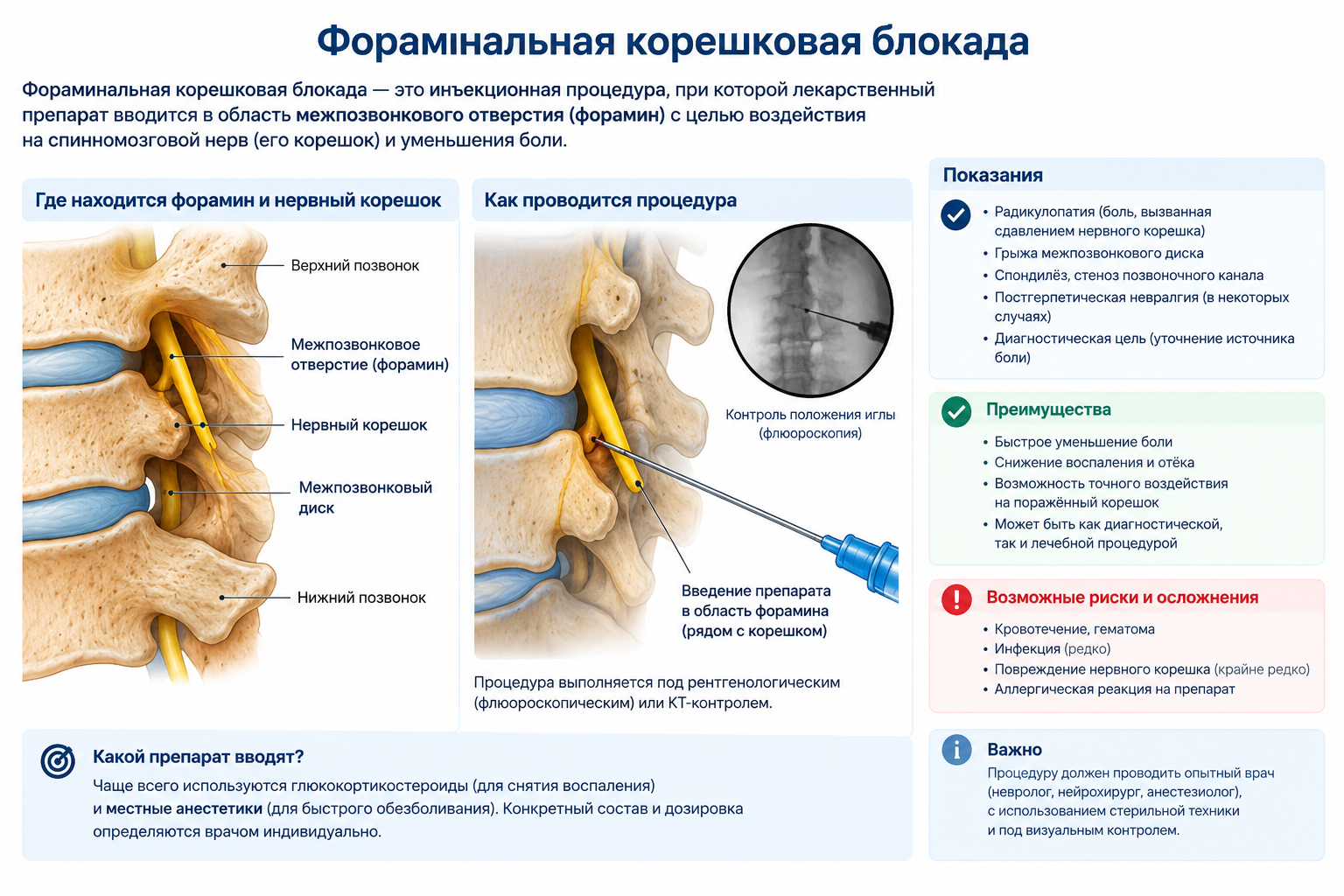Селективная фораминальная корешковая блокада — когда боль в ноге или руке уходит без операции