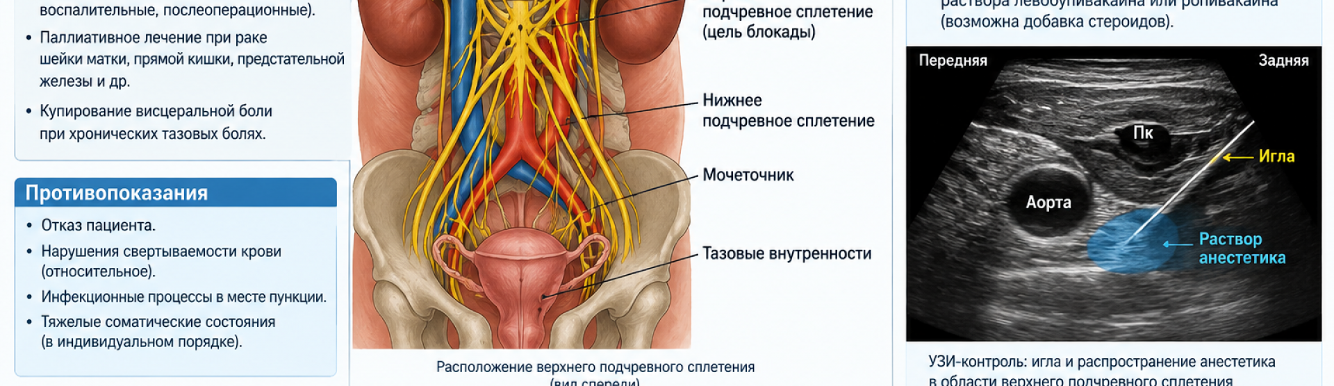 Верхняя гипогастральная блокада у м. Чкаловская, Спортивная, Горьковская, Петроградская, Крестовский остров
