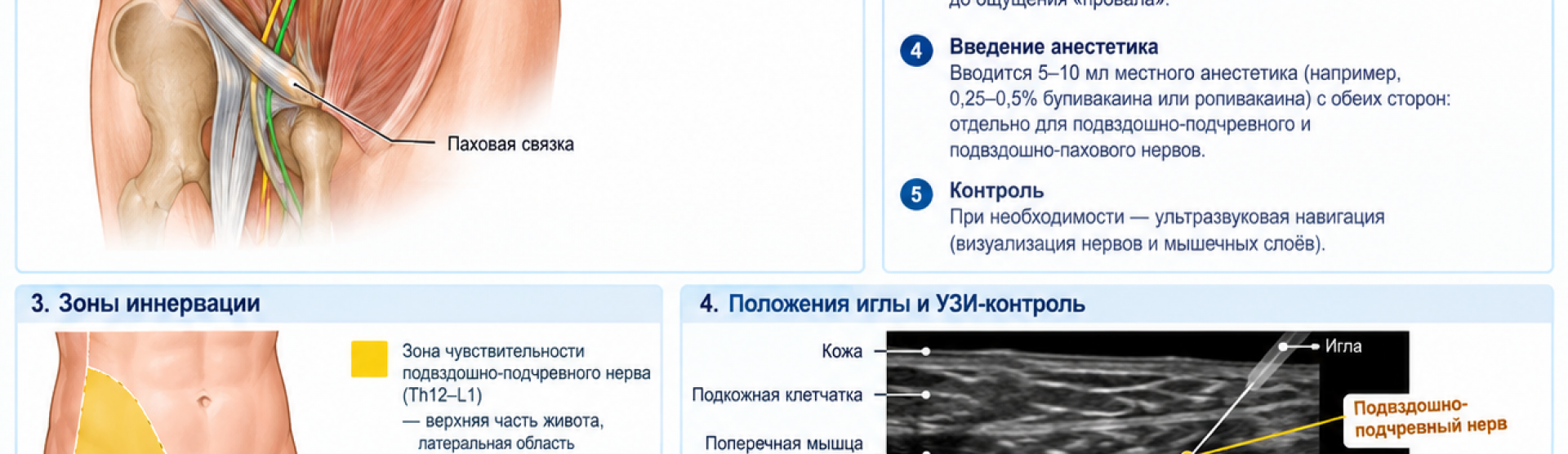 Блокада подвздошно-пахового и подвздошно-подчревного нервов у м. Чкаловская, Спортивная, Горьковская, Петроградская, Крестовский остров
