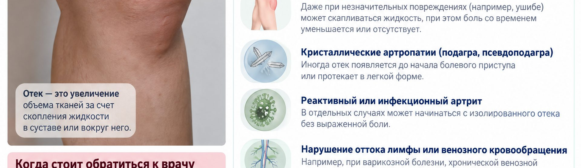 Отёк колена без боли — причины скрытого воспаления, чем опасно | Донской Э.О., СПб